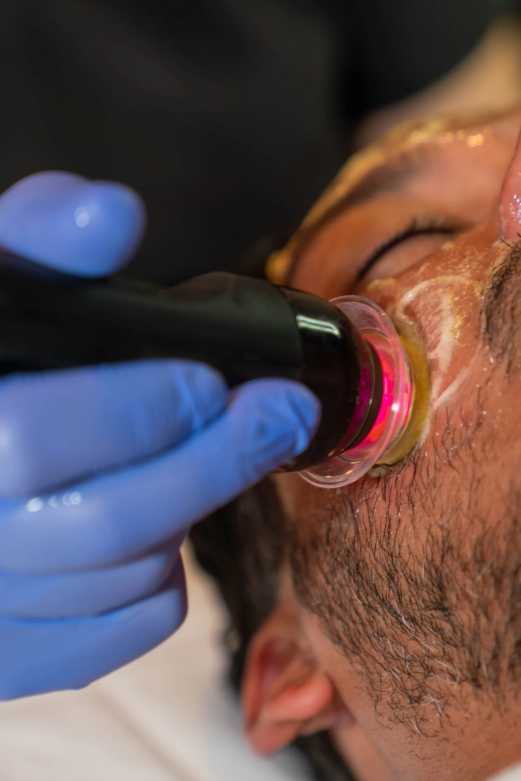 Advanced facial device targeting clogged pores and dull skin texture at Gold Skin Care Nashville